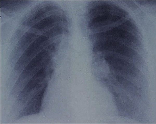 lung-cancer